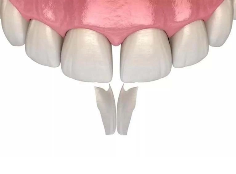 Composite Bonding