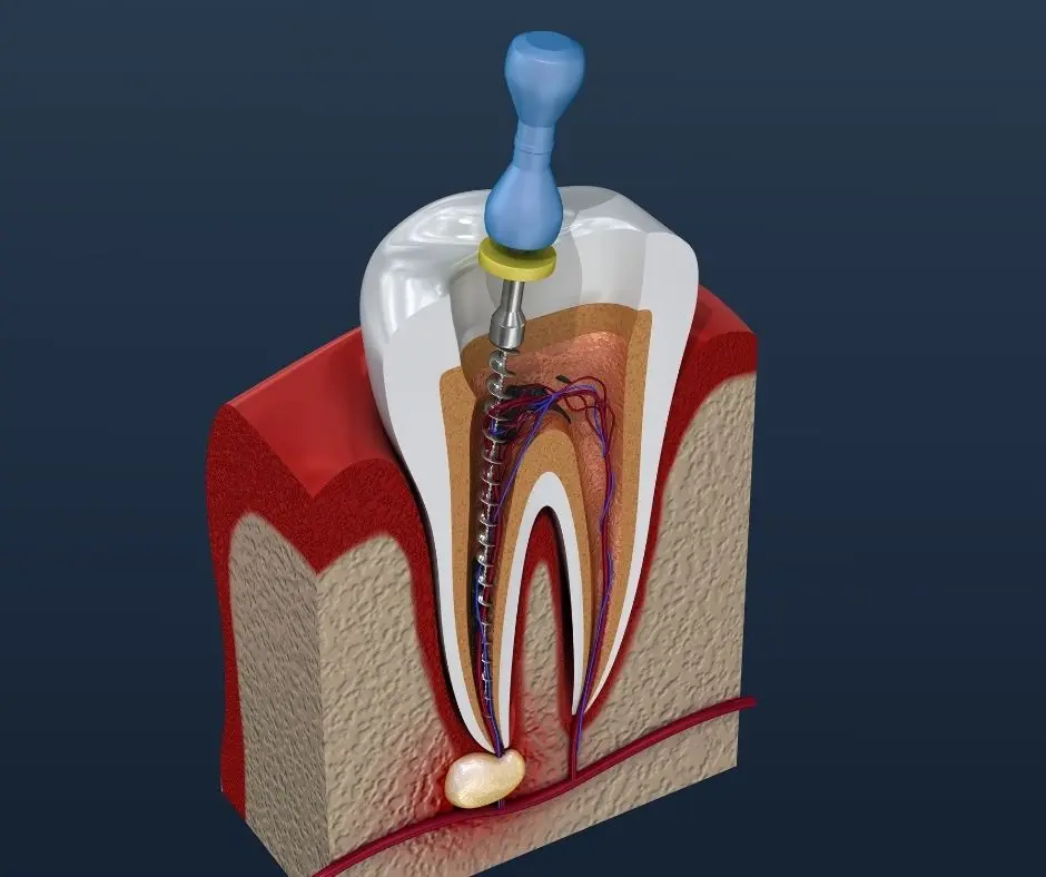 Root Canals
