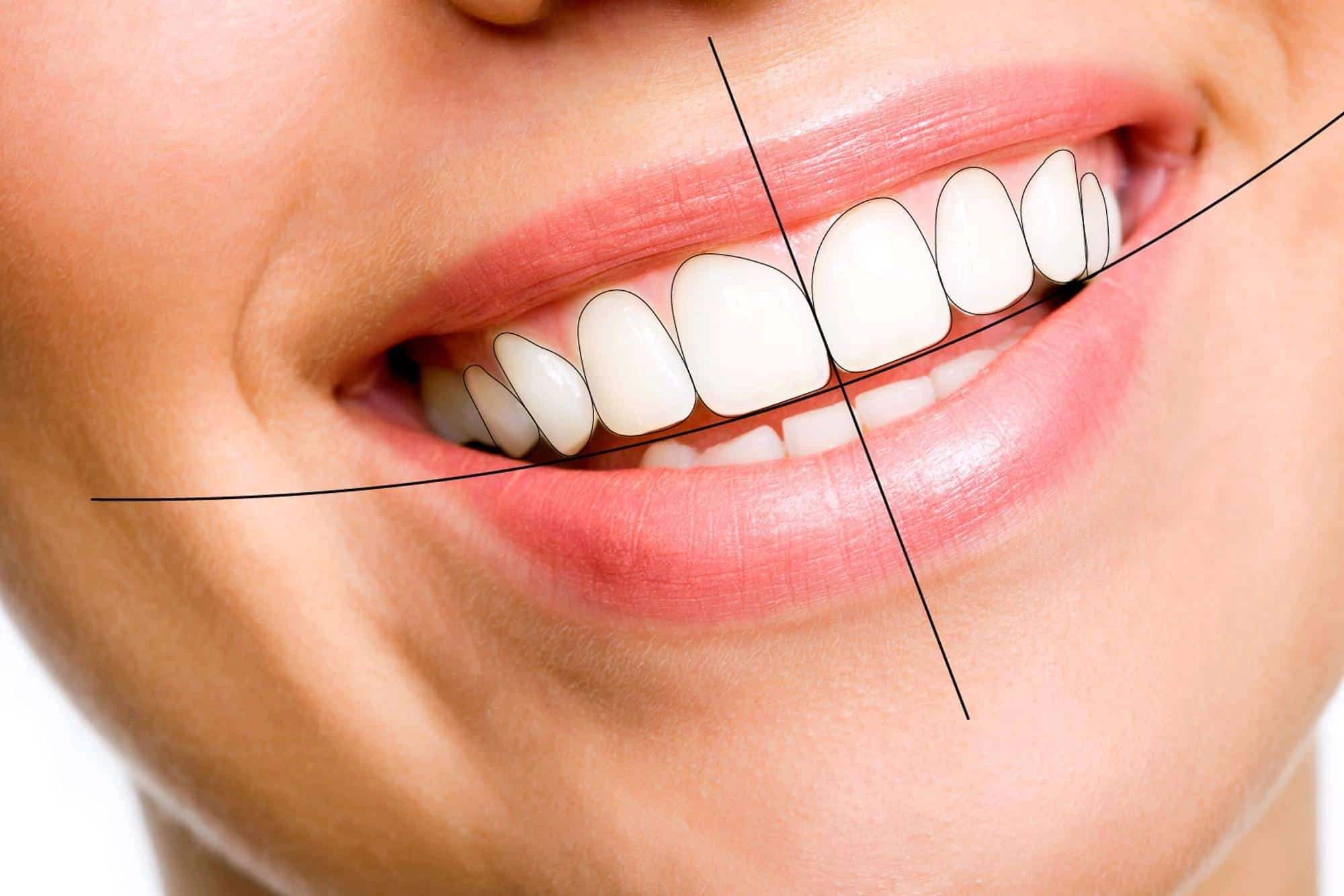 Smile Design
