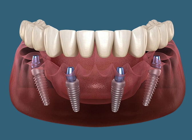 Teeth In A Day (1)