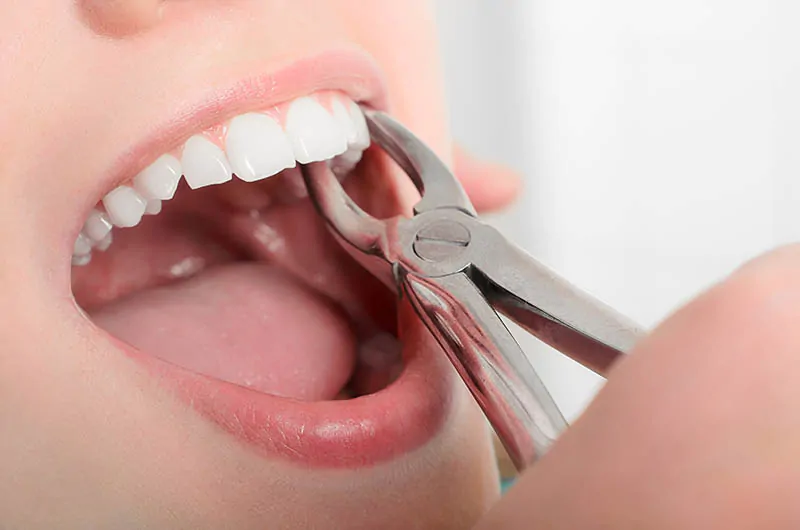 Tooth Extractions