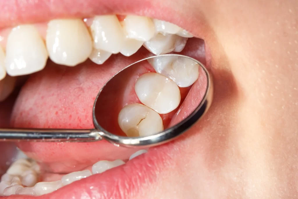 Fillings