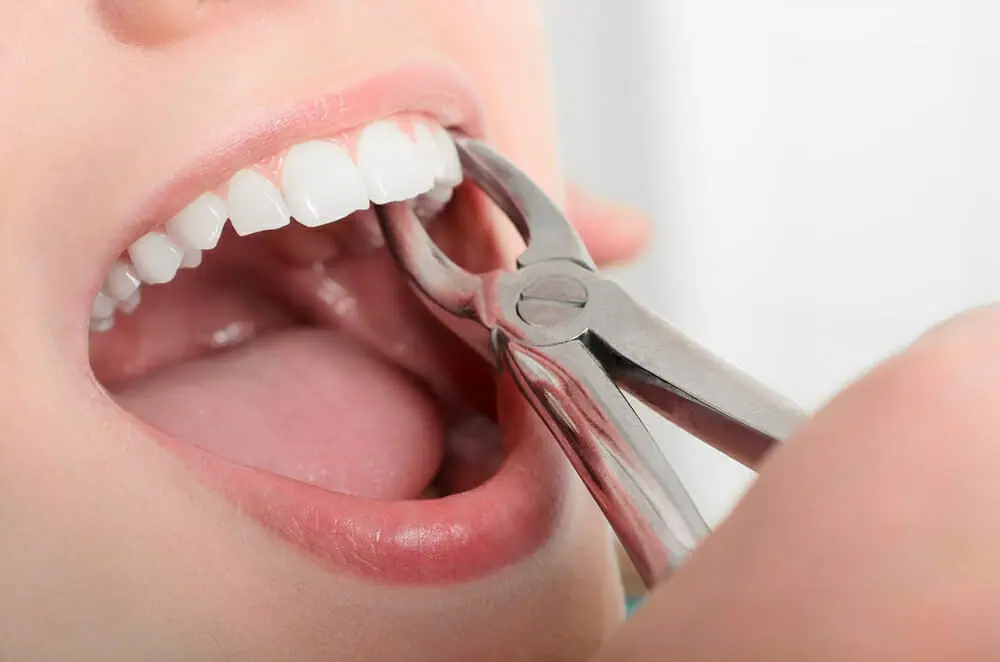 Extractions 1