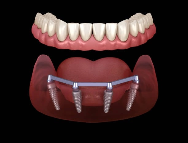 Implants 1