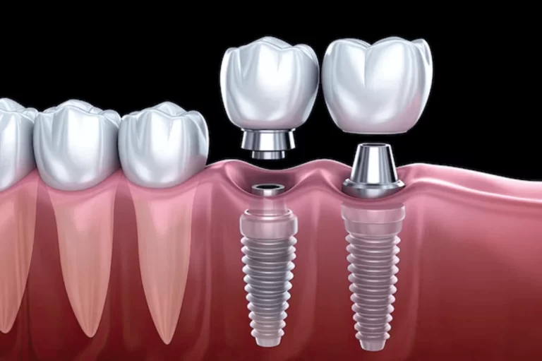 Implants