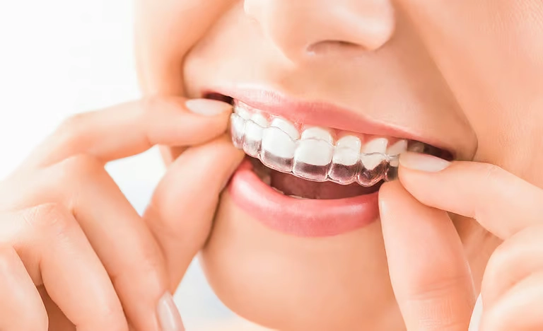 Invisalign 11