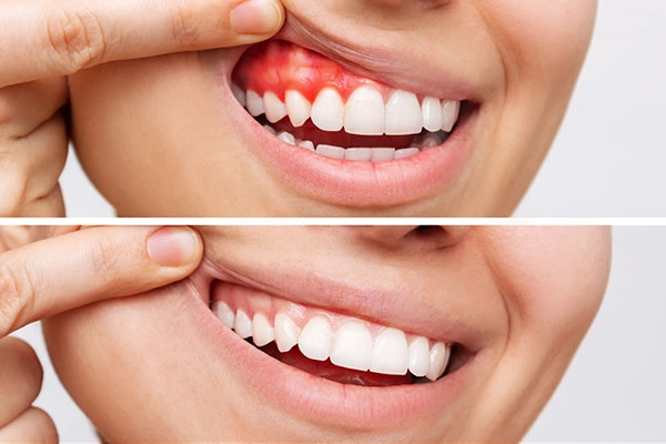 Periodontal 2 (1)