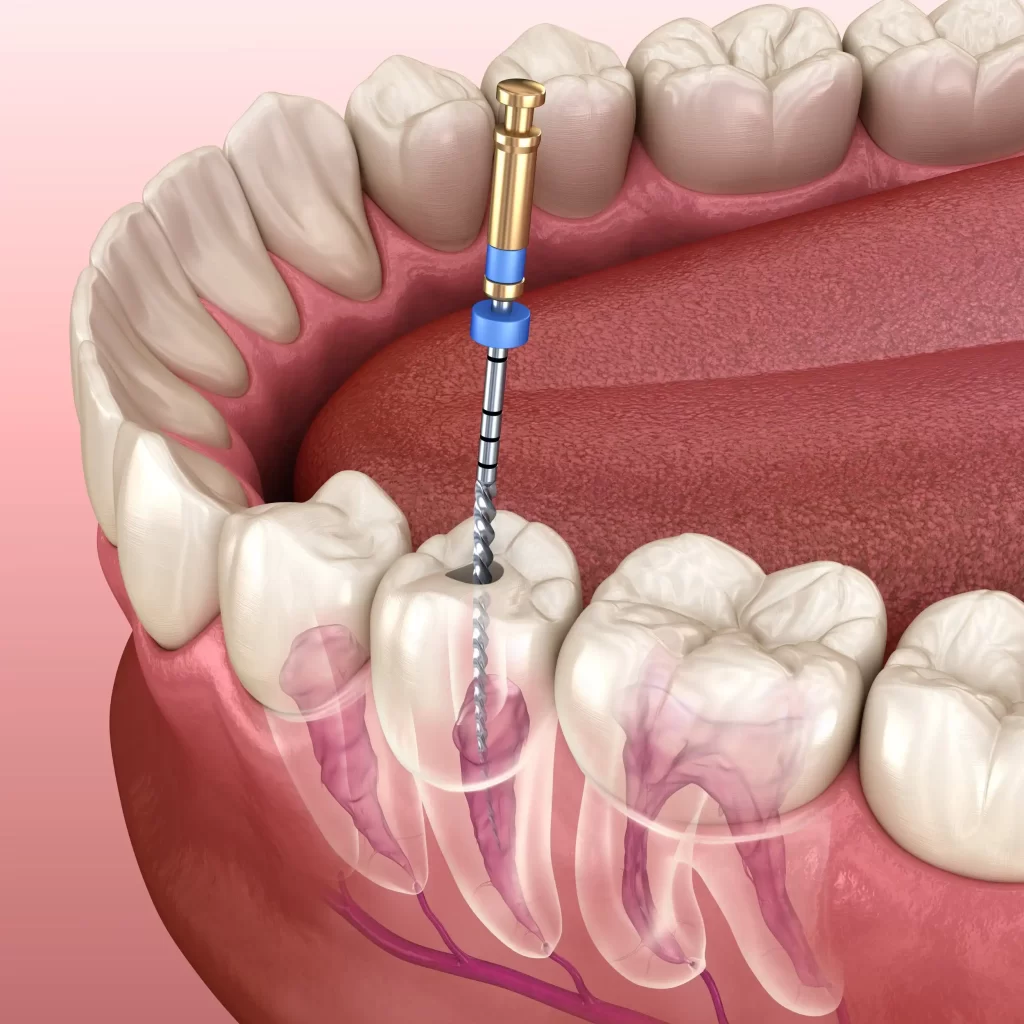 Root Canals 1