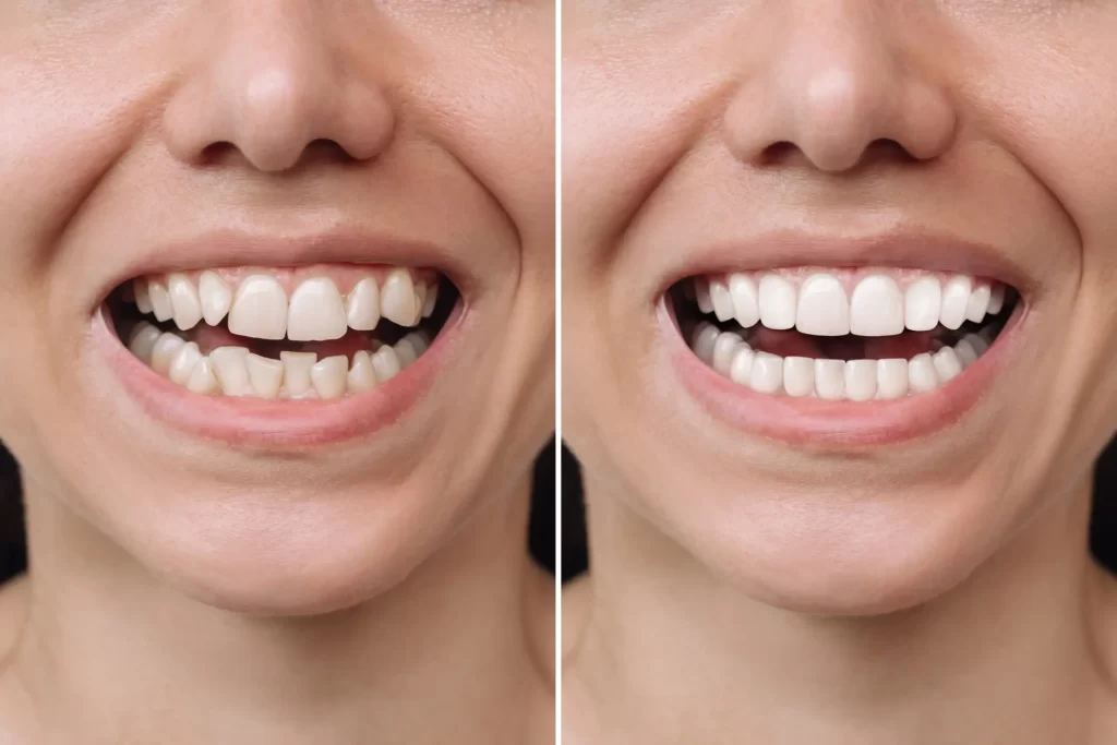 Veneers 1
